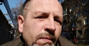 Ветеран з травмами обличчя після конфлікту з ТЦК у Шевченківському районі Києва